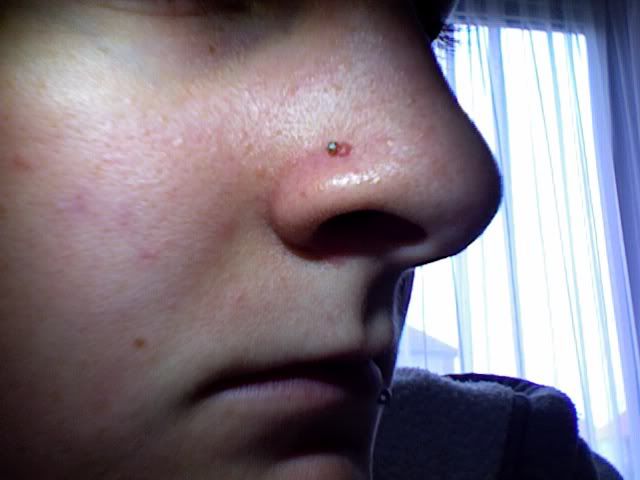 This is the ugly lump by my piercing. Comment on tabbiietots's Answer: