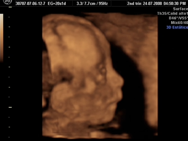 3d ultrasound pictures at 20 weeks. 3d ultrasound 20 weeks boy.