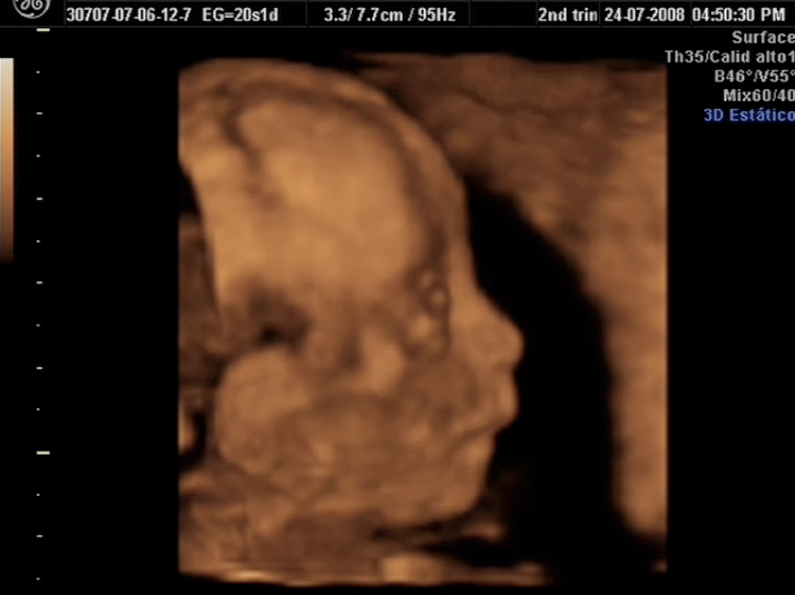 20 Week Scan